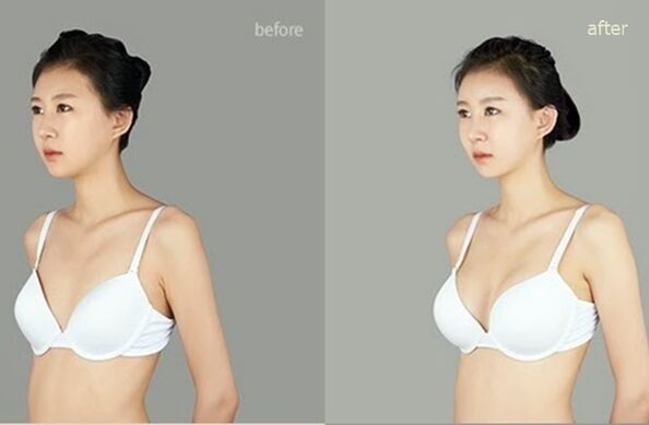 avant et après augmentation mammaire plastique