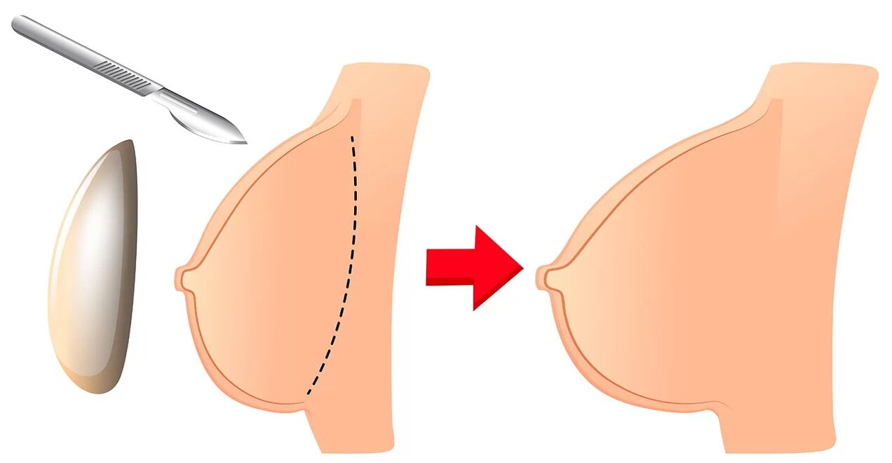 Augmentation mammaire avec un implant