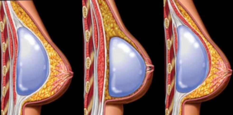 Installation d'implants