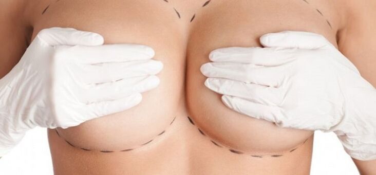 Augmentation mammaire par chirurgie